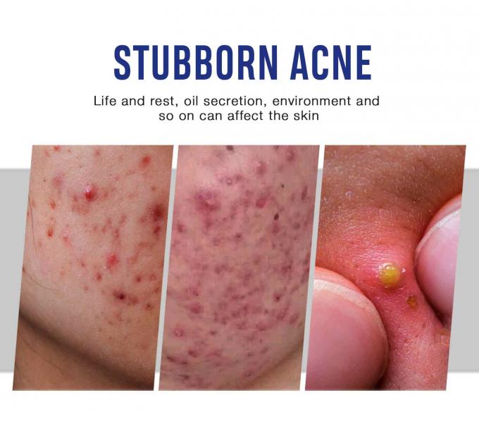 Lightening and Repairing Acne Scars Natural Organic Acne Treatment Cream Quantity 1000 7