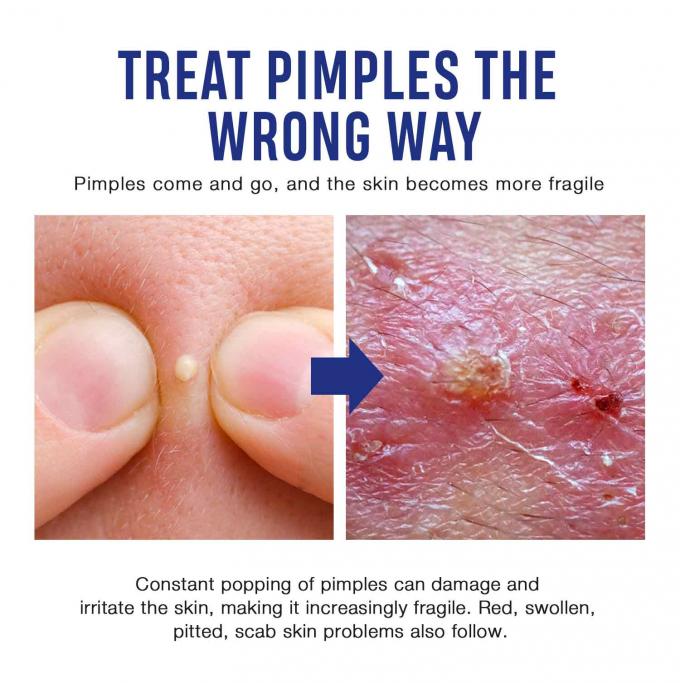 Lightening and Repairing Acne Scars Natural Organic Acne Treatment Cream Quantity 1000 8
