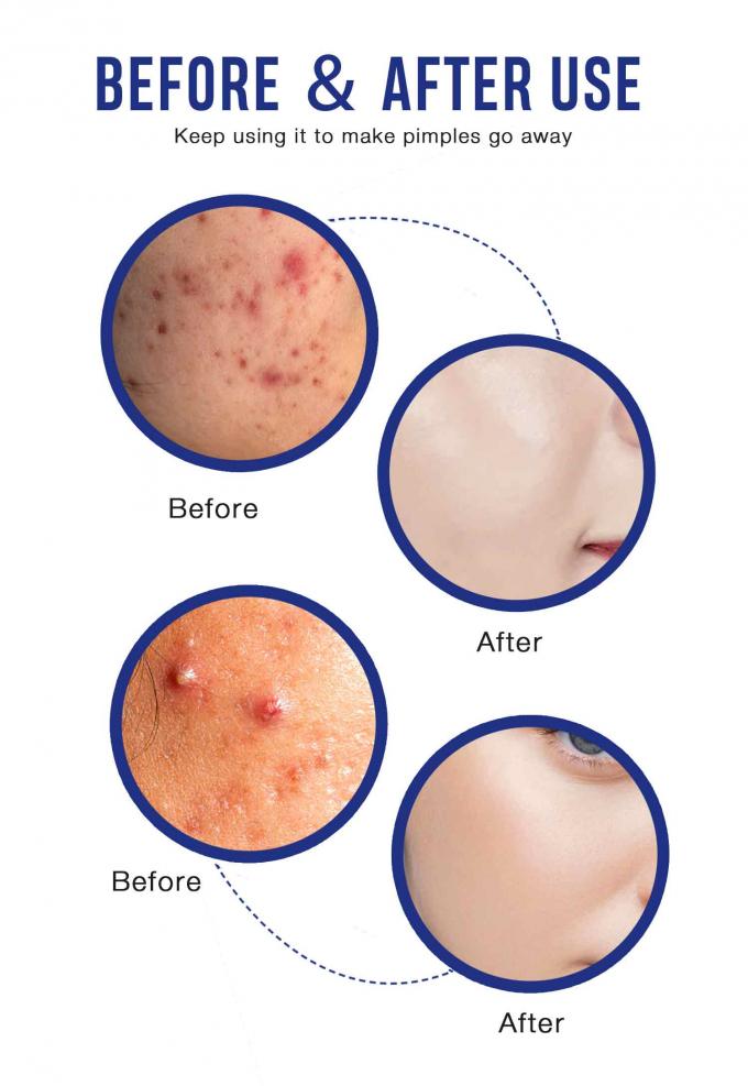 Lightening and Repairing Acne Scars Natural Organic Acne Treatment Cream Quantity 1000 9