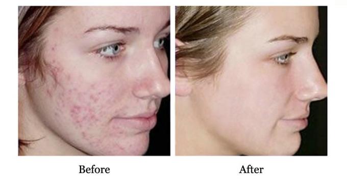 Advantage of QBEKA Protein Peptide Serum Water Retention and Acne Scar Repair 10ml 6