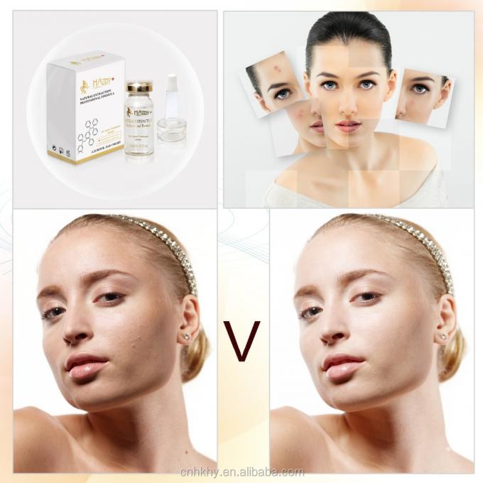 Remove Acne Scars with QBEKA Happy Cosmetics Levorotatory VC Original Liquid Bio Serum 0